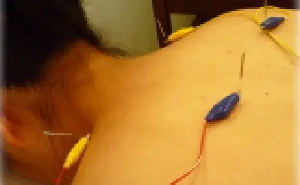 低周波 鍼通電療法とは